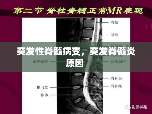 突发性脊髓病变，突发脊髓炎原因 