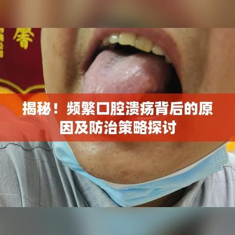 揭秘！频繁口腔溃疡背后的原因及防治策略探讨